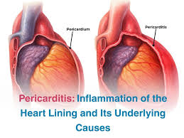 Image result for Pericarditis