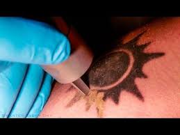 Lasers work by providing a burst of energy in a very short time frame. Science Of Laser Tattoo Removal Awesome Sauce Laser Tattoo Tattoo Removal Cost Tattoo Removal