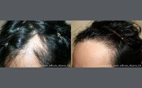 Neograft Before And After Courtesy Of Keith Jeffords Or Paramount Plastic Surgery In Atlanta Ga Plastic Surgery Help Hair Loss Hair Restoration