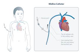 Image result for Peripheral IV Access