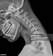 Image result for Skull XRay