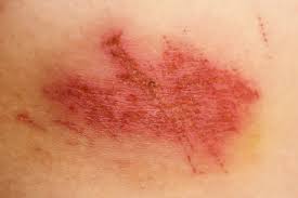 Impetigo Skin Infections In Children