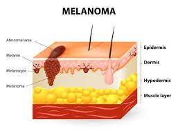 Cancer is the uncontrolled growth of abnormal cells in the body. Sun Damage And Cancer