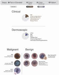 Image result for Blue Nevus