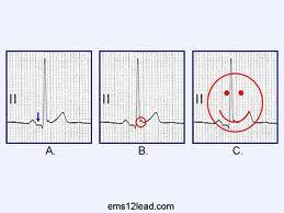 As causas da pericardite aguda vão desde infecções virais até o câncer, o qual é potencialmente letal. Ecg Na Pericardite Aguda Cardiopapers