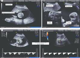 Stff Secuencia Oligoamnios Polihidramnios Grave Con Stuck Twin Y Download Scientific Diagram