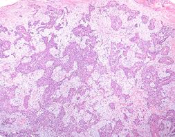 Image result for Glomus tumor