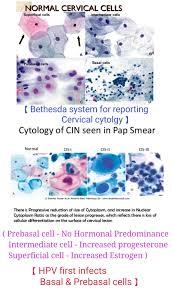 Cervical Cytology Normal Abnormal Note Increase Nucleus Cytoplasmic Ratio Loss Of Differentiation In Cin Cervix Uterina Cuello Uterino Ciencia