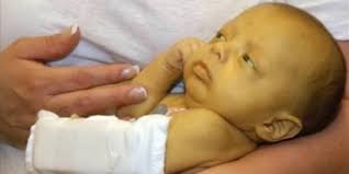 Penyakit kuning terjadi akibat adanya gangguan metabolisme di dalam organ hati sehingga terjadi penumpukan bilirubin di dalam tubuh. Mengenal Bayi Kuning Atau Ikterik Neonatorum Rsud Kelet