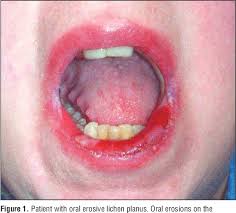 Image result for lichen planus on tongue)