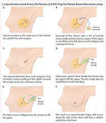 If she&#x27;d stuck with the treatment plan her local medical team had recommended, she would have had the wrong treatment and surgery. Breast Cancer Treatment