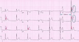 Image result for Early Repolarization