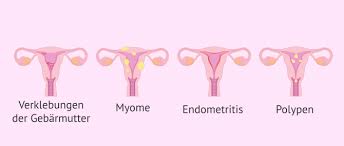 Das hauptmerkmal der adenomyose ist, dass das endometrium nur im myometrium (mittlere schicht des keimende zellen des endometrialen gewebes in der gebärmutter (myometrium) erfüllen. Kontraindizierte Schwangerschaft Leihmutterschaft Als Losung