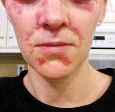 my battle with eczema perioral dermatitis and corticosteroid cream my merry messy l perioral dermatitis treatment perioral dermatitis seborrheic dermatitis