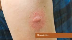 Image result for flea bites