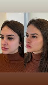 ✨ A Thayne tem apenas 28 anos e passou por um processo incrível de  emagrecimento, eliminando 10kg. Mas, junto com a conquista, veio uma  preocupação: ela sentiu que o rosto havia “derretido” e que seu ...