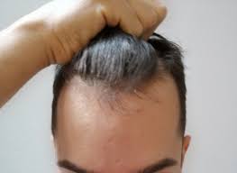Du willst wissen, welche frisur dir steht? Fallen Meine Geheimratsecken Stark Auf Frisur Friseur Haarausfall