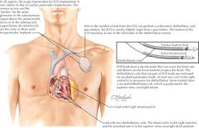 It also contains a computer that tracks your heart rate and rhythm. Defibrillator And Pacemaker