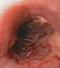 The aims of this study were to investigate the implications of the endoscopic findings for the. Herpes Esophagitis Wikipedia
