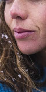 If you are an athlete spending a lot of time outside use these tips to prevent and treat windburn. How To Treat Wind Burn On Face And Stop It From Happening Again Self