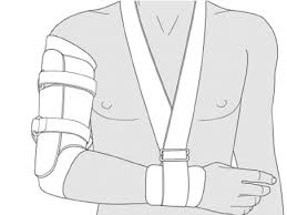 Functional bracing for the treatment for later. A Diagram Of A Functional Humeral Brace Download Scientific Diagram