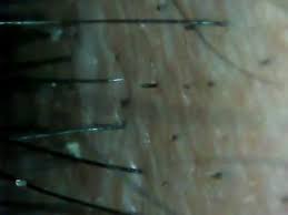 They are commonly observed in alopecia areata, dissecting cellulitis 4, 5, trichotillomania and tinea capitis. Black Dots Destroyed Hairs In The Hair Follicle Opening 03 å††å½¢è„±æ¯›ç—‡ Youtube