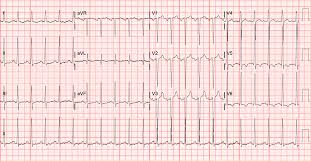 Histopathology of (a) normal myocardium and (b) myocardial hypertrophy. View Sokolow Lyon Criteria à¸„ à¸­ Transparant Best Info