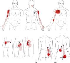 Image result for Pain Disorder