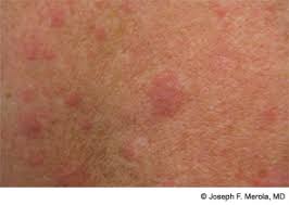 Image result for Vasculitis