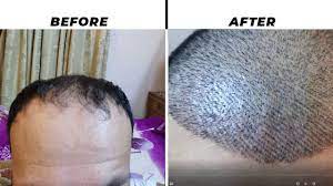 12 Days Later 6800 Greft Hari Transplant Transplant Day Hair Transplant