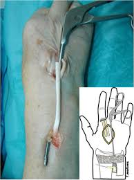 We hope this picture right arm muscle and tendon anatomy can help you study and research. Fds4 Tendon Was Grasped On The Dorsal Side Of Distal Third Of The Download Scientific Diagram
