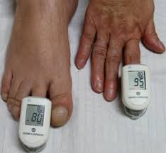 Image result for Clubbing nails feet