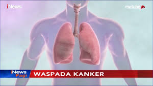 Waspada Kanker Paru Paru Ini Gejala Awal Yang Harus Diperhatikan Inews Pagi 10 07 Youtube
