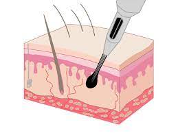 The notion of a needle in the eye seems pretty horrible to most people. Australia S Science Channel Skin Deep Science How Do Tattoos Work
