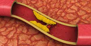 What Causes Blood Clots In Legs And How To Prevent And Treat