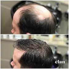 Hairskeen Transformation Men S Hair Loss Hair Loss Men Hair Loss Hair Replacement