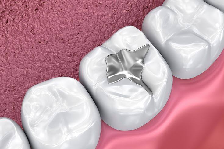 Dental Fillings product image