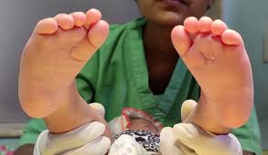 Surgery used to be the main treatment for clubfoot, but orthopedic surgeons (doctors who focus on conditions of the bones, muscles, and joints) now prefer the ponseti method.this is done in two phases: Clubfoot Or Congenital Talipes Equinovarus Ctev Young Bones Clinic