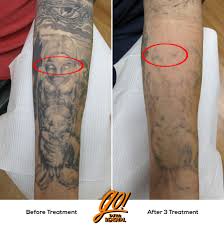 White ink tattoo is partly can be change. White Ink Shifting Dark A Real World Example Tattooremoval