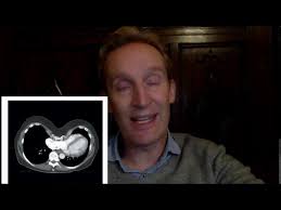 The Scandal of Pectus Excavatum surgery being denied by the NHS in England