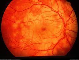 Apmppe — acute posterior multifocal placoid pigment epitheliopathy … the new mediacal dictionary. Acute Posterior Multifocal Placoid Pigment Epitheliopathy Apmppe Sciencedirect