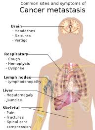 Cancerous cells may spread to other areas of the body, particularly the bones and lymph nodes. Cancer Wikipedia