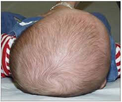 Neurodevelopmental Implications of head positioning in term and preterm  infants