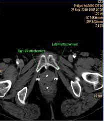 The floor of the pelvis is made up of the muscles of the pelvis, which support its contents and maintain urinary and faecal continence. Above Shows A Number Of Possible Measurements Using Mri Imaging A Download Scientific Diagram