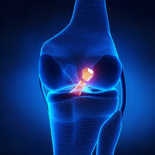 We did not find results for: Acl Reconstruction Surgery What A Surgeon Must Know