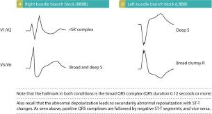 Left Bundle Branch Block Lbbb Ecg Criteria Causes Management Ecg Echo Bundle Branch Block Conduction Branch