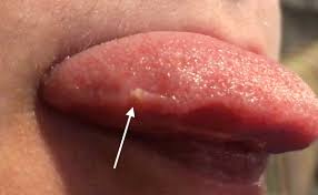 I just took notice of them a year or less ago. Transient Lingual Papillitis Wikipedia