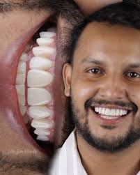 Estética dental vai muito além de dentes claros. Envolve planejamento,  respeito à anatomia, harmonia facial e responsabilidade profissional. Cada  detalhe desse sorriso foi pensado para manter naturalidade, função e  longevidade. 10 lentes