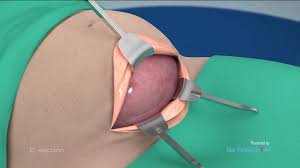 Image result for c section