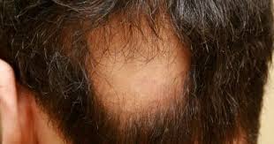 How To Get Rid Of Ringworm Hair Loss Alopecia Hair Loss Treatment Help Hair Loss